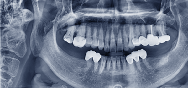 [상악동 거상술 (lateral window sinus graft)] 후