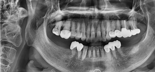 [상악동 거상술 (lateral window sinus graft)] 전